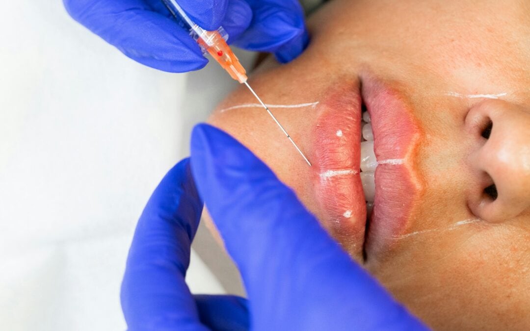 Dealing With Allergic Reactions to Dermal Fillers