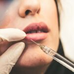 Lip Filler
